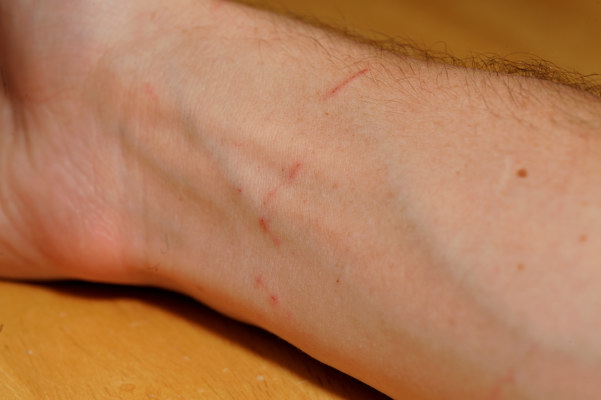cat scratches